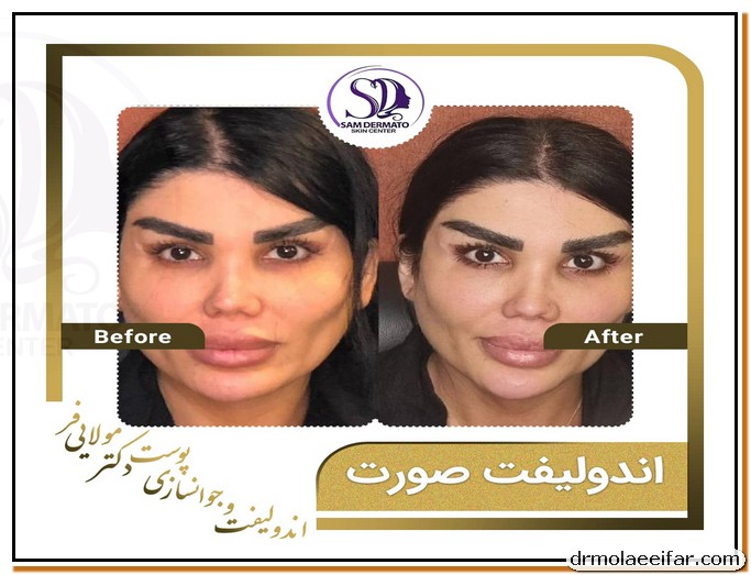 Endolift of the face of Dr. Moulai Far 4