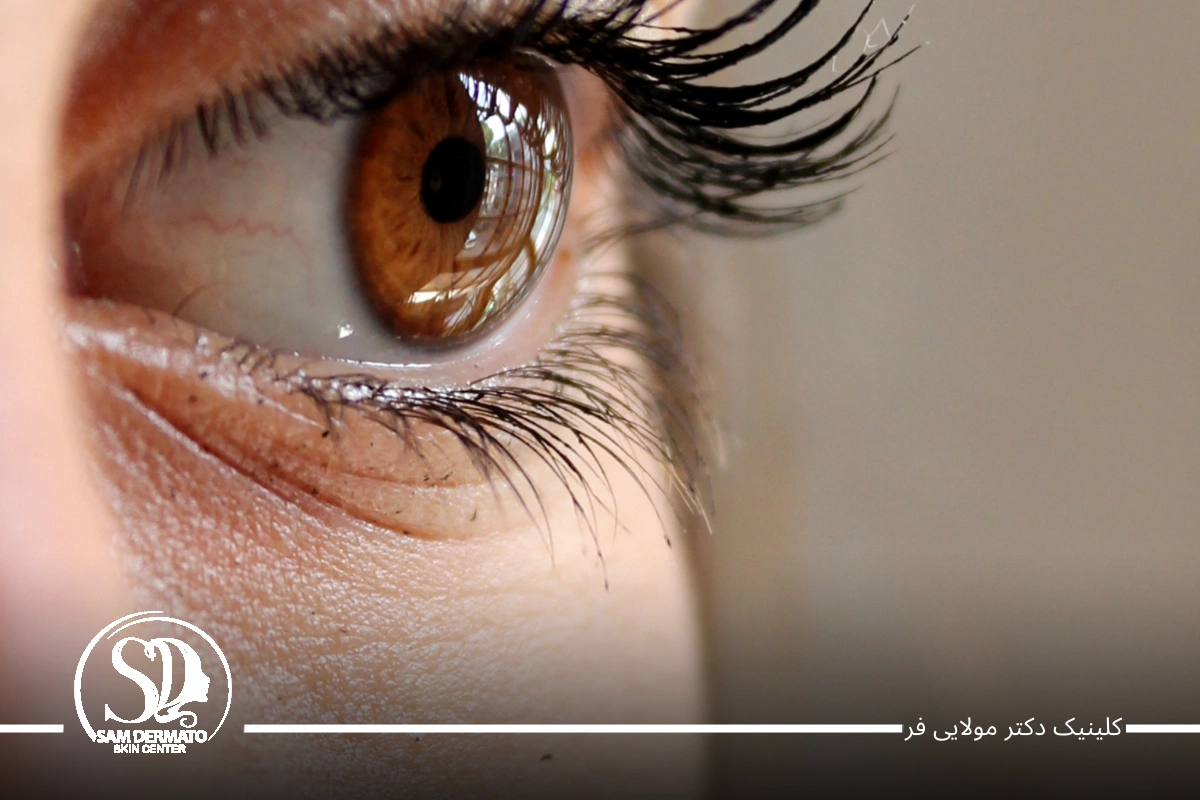 اندولیفت زیر چشم