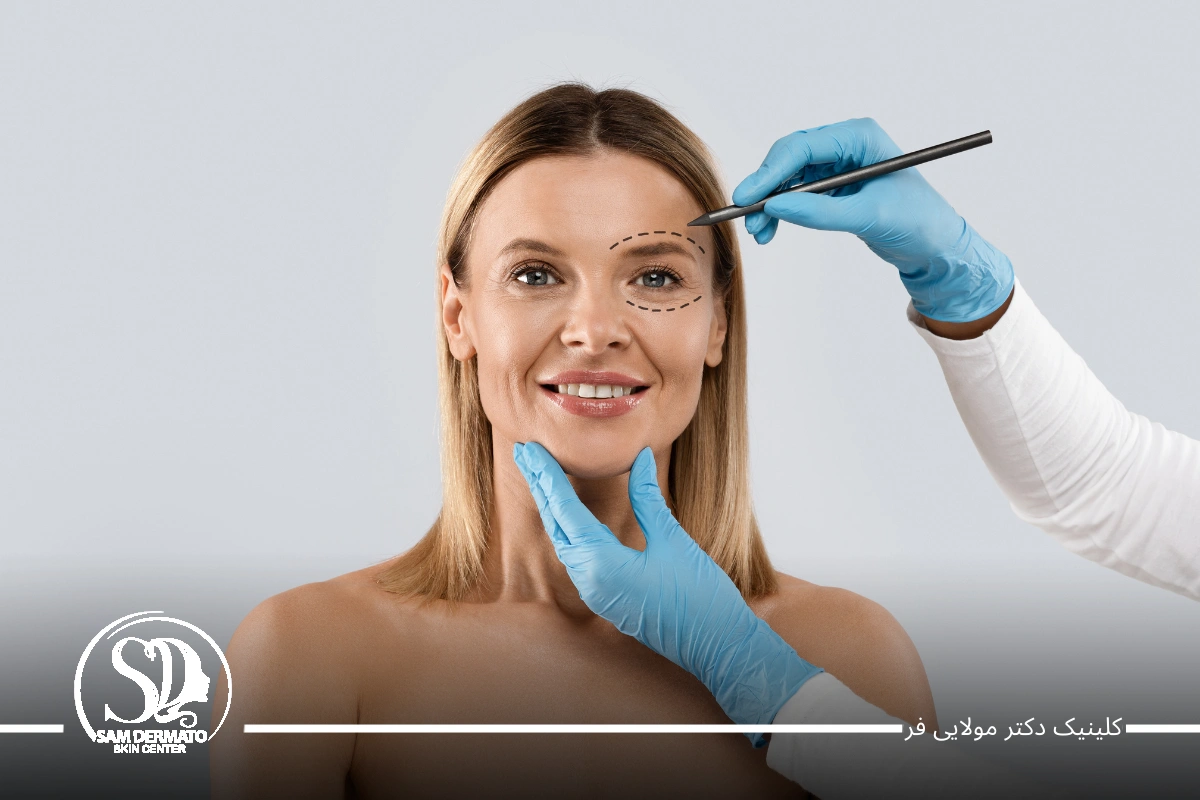 اندولیفت زیر چشم