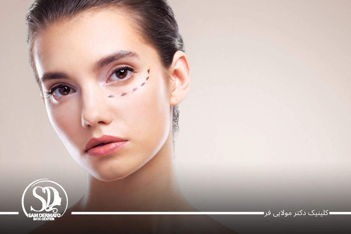 اندولیفت زیر چشم