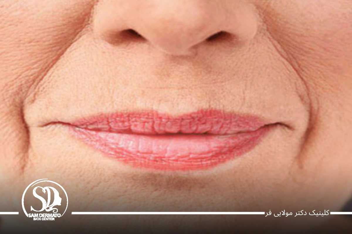 اندولیفت خط خنده