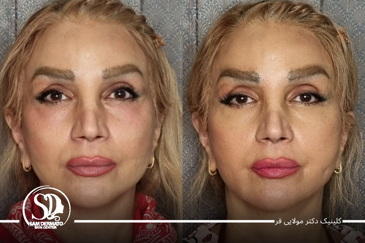 اندولیفت خط خنده