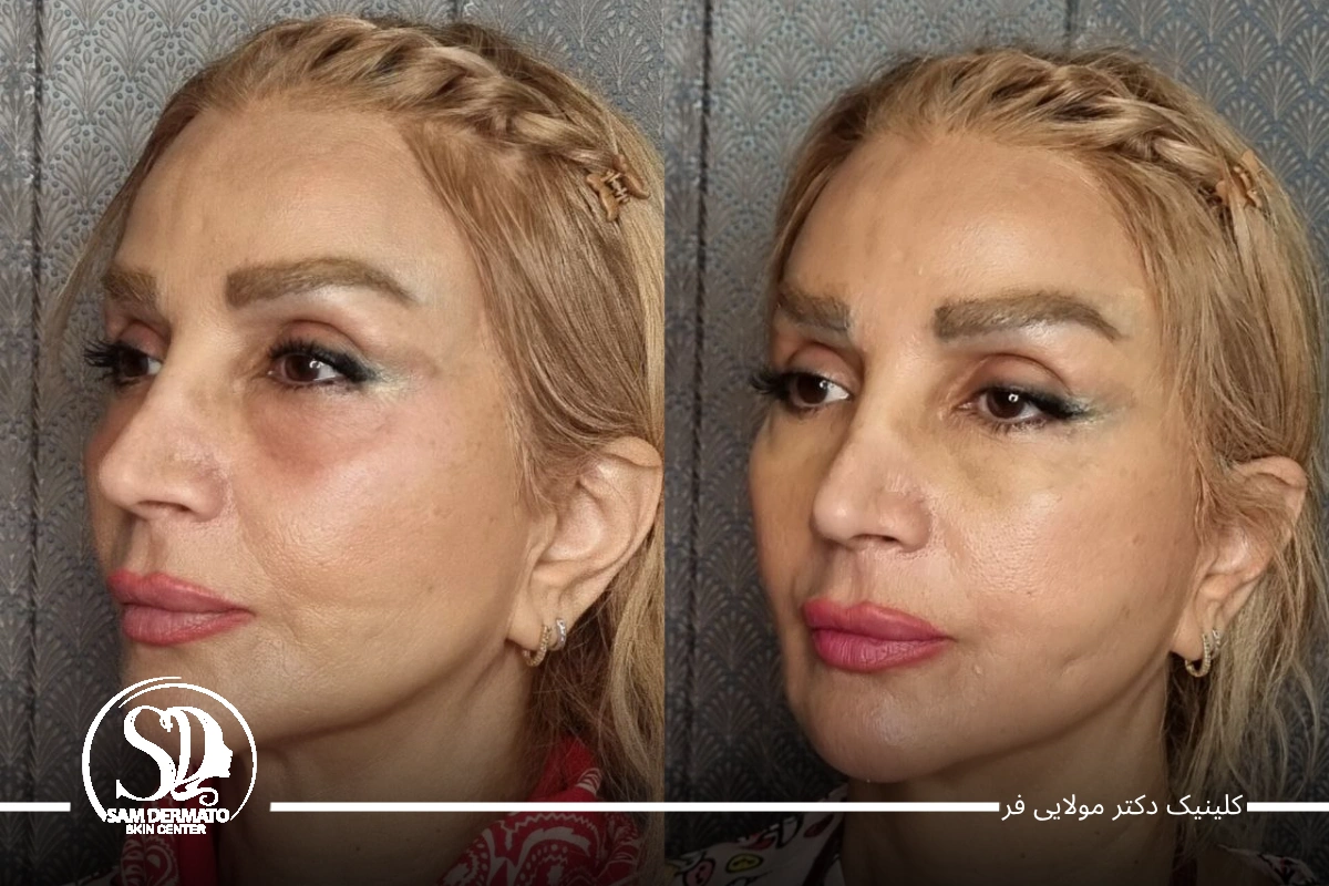 اندولیفت خط خنده