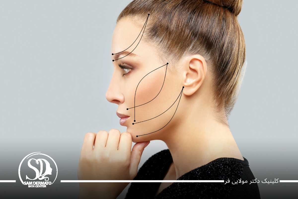اندولیفت گونه