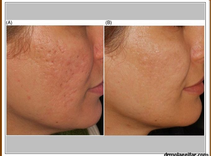 Endolift scar and acne