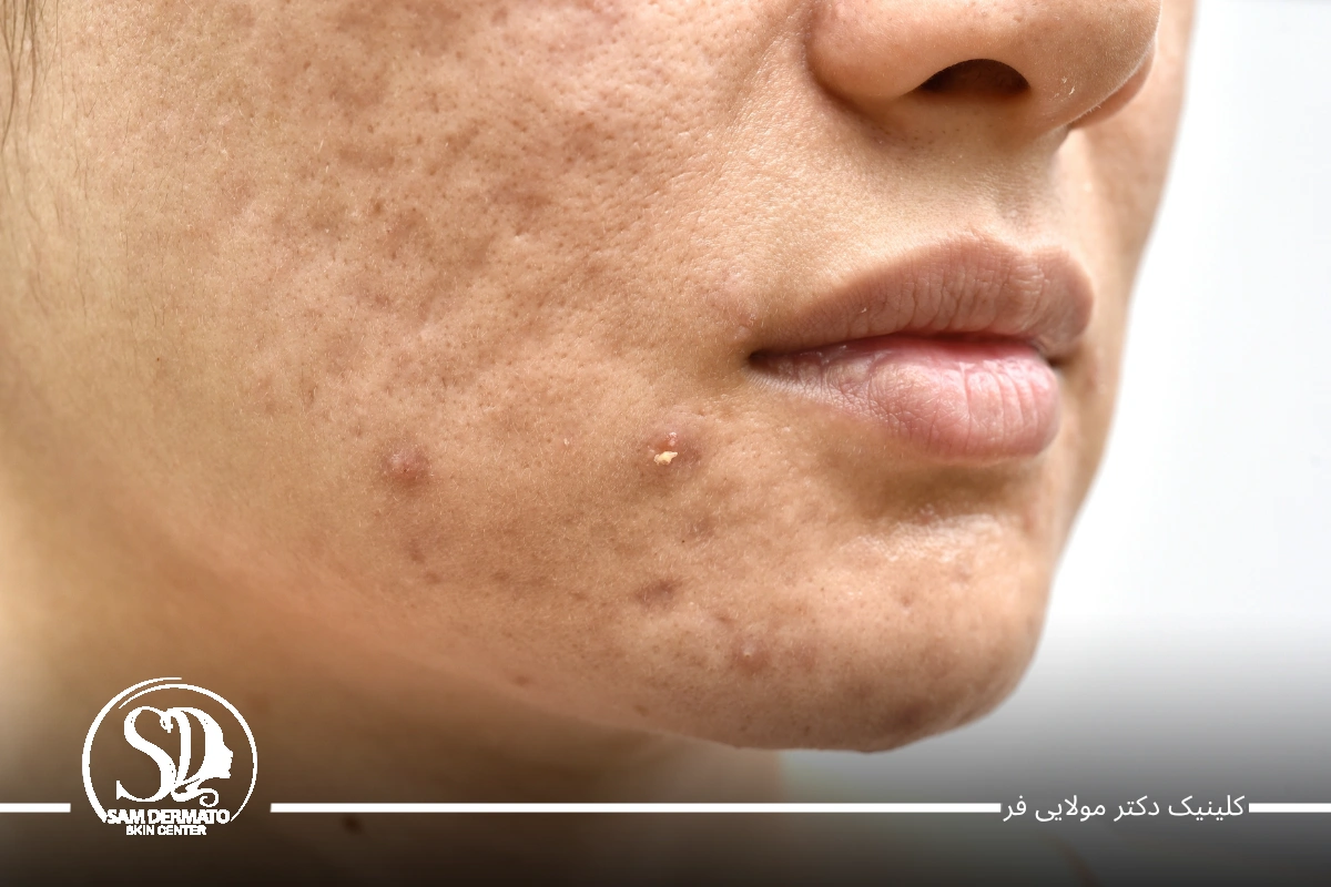 اندولیفت اسکار و اکنه