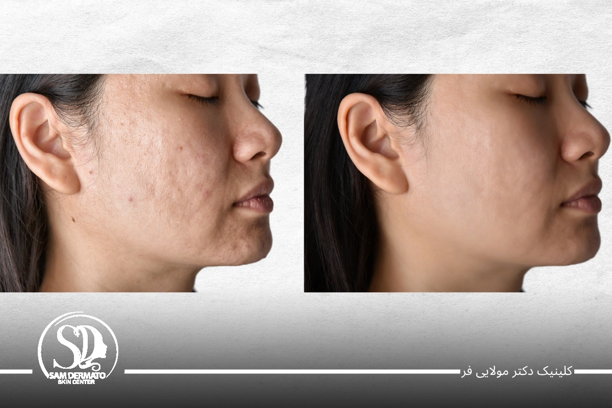 اندولیفت اسکار و اکنه