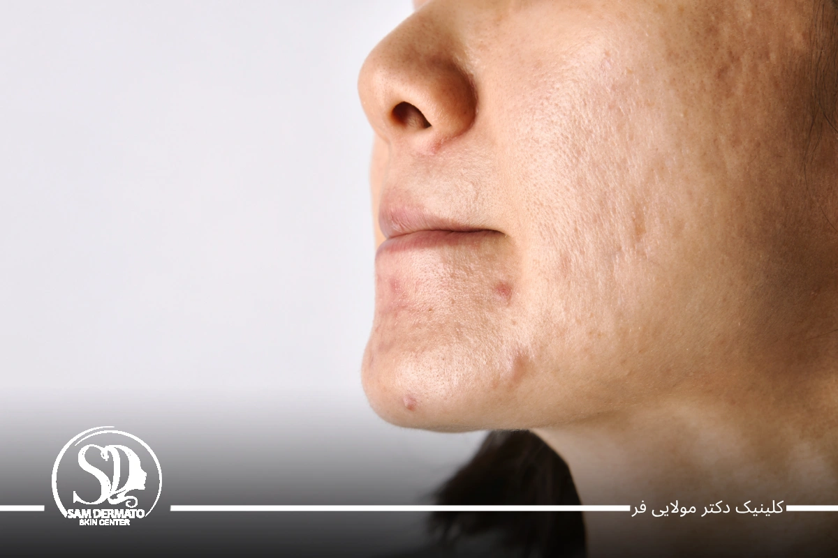 اندولیفت اسکار و اکنه
