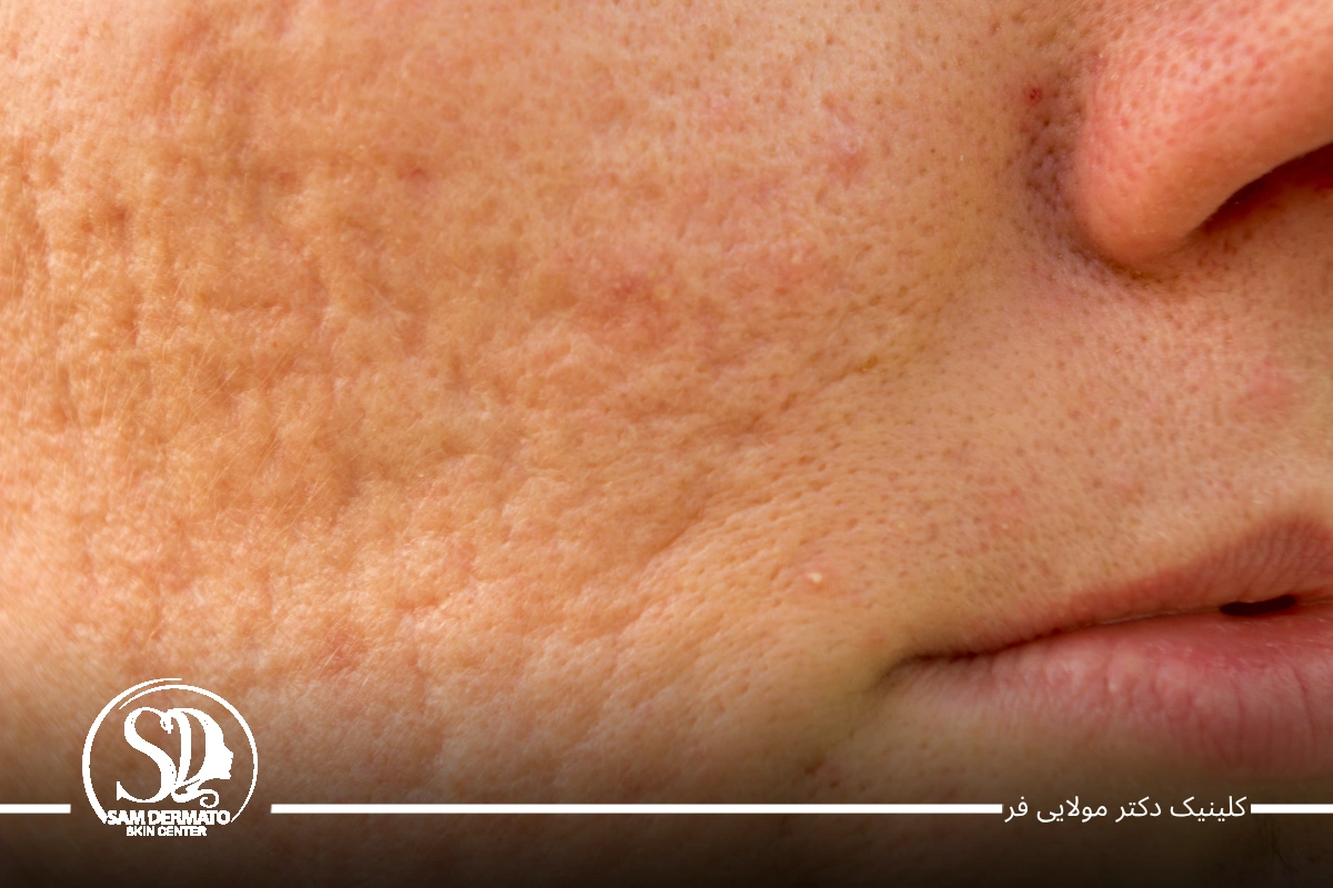 اندولیفت اسکار و اکنه