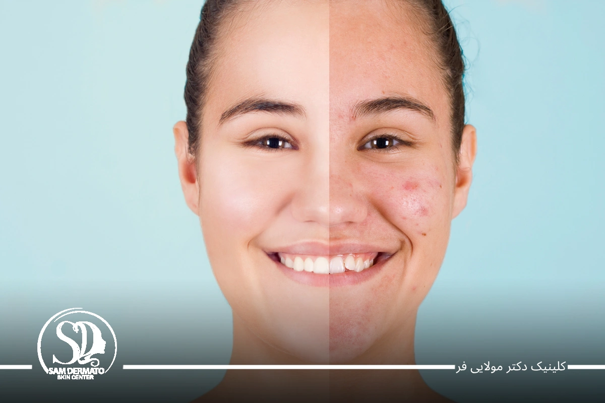 اندولیفت اسکار و اکنه