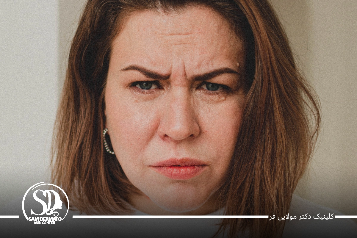 اندولیفت خط اخم