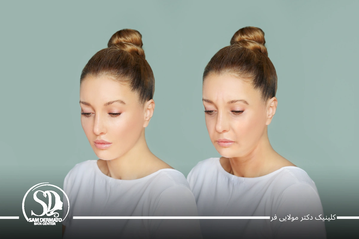 اندولیفت خط اخم