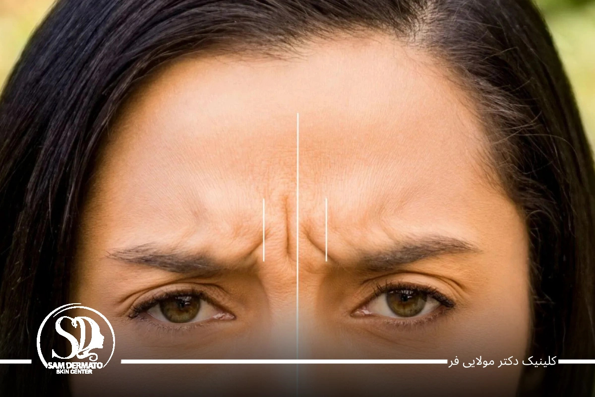 اندولیفت خط اخم