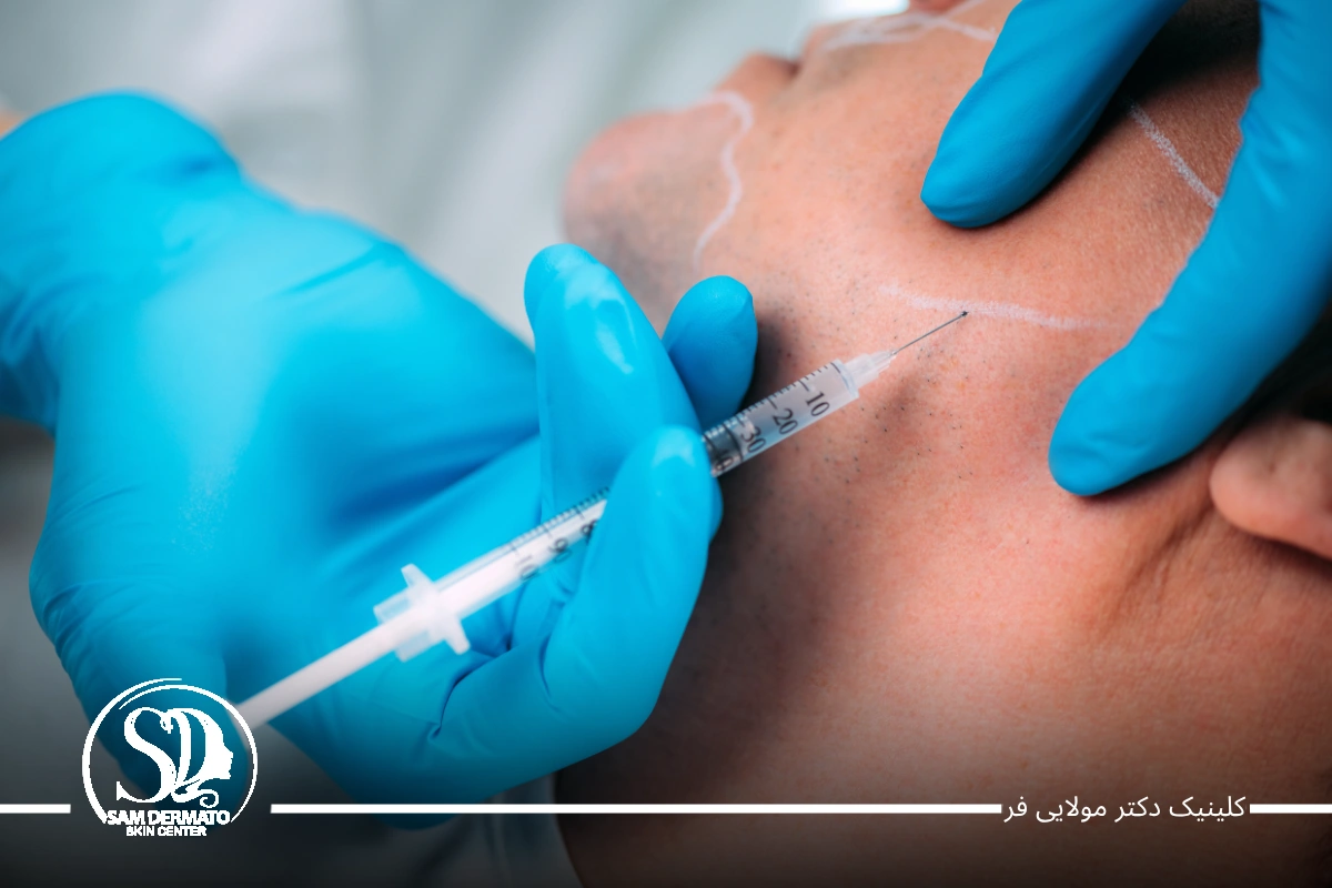 اندولیفت خط فک