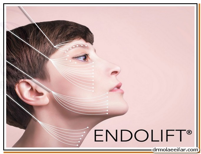 Cheek endolift price