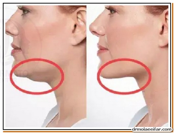 The price of endolift neck 3 1