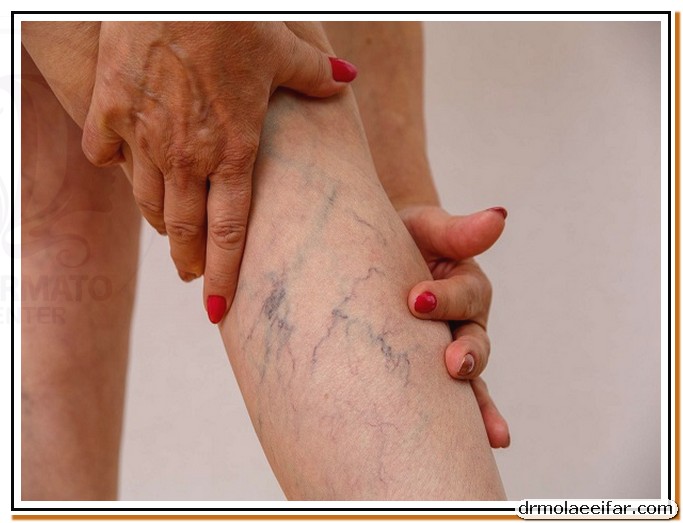 Treatment of superficial varicose veins with endolift 1