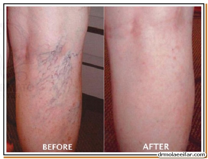 Treatment of superficial varicose veins with endolift 3 1