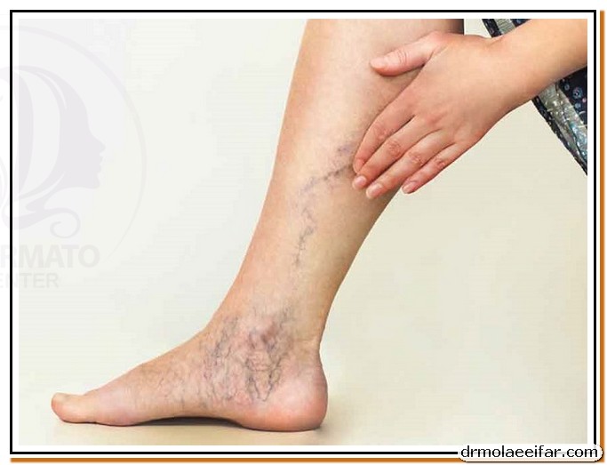 Treatment of superficial varicose veins with endolift 4 1