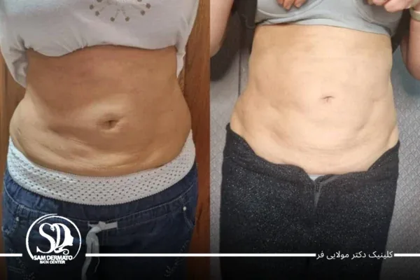 تصویر مقایسه قبل و بعد اندولیفت شکم