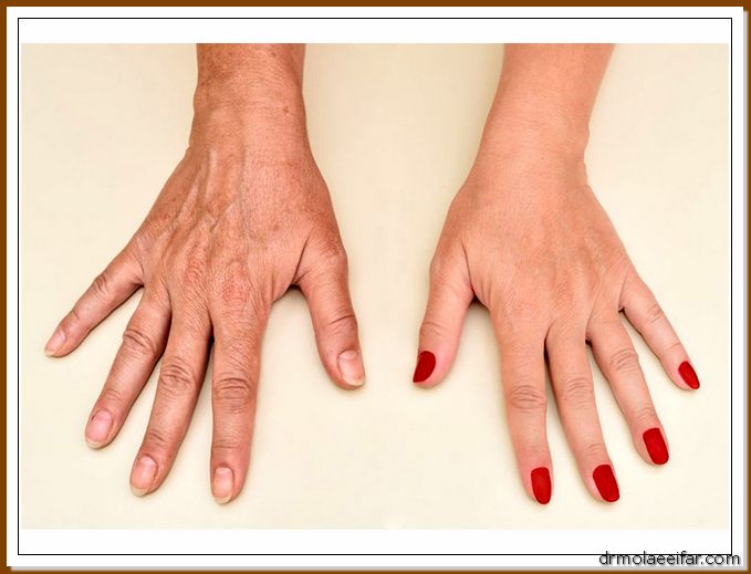 Hand endolift 4