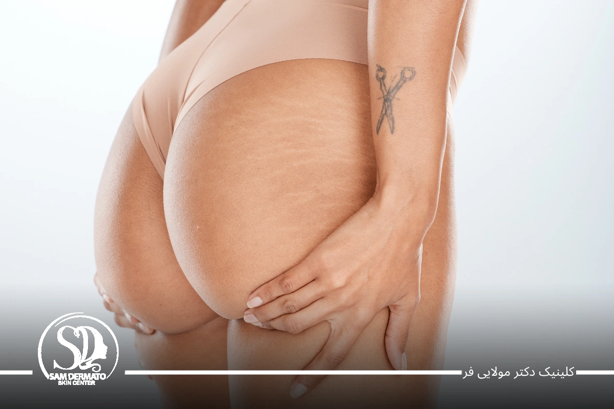اندولیفت باسن