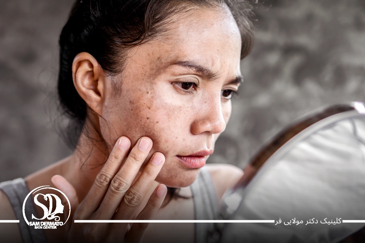 اندولیفت برای بهبود لک‌های پوستی