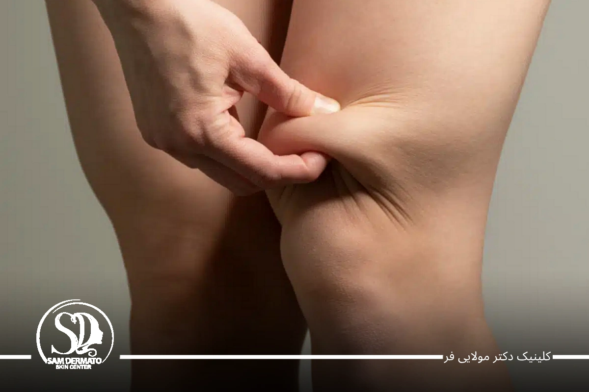 اندولیفت زانو