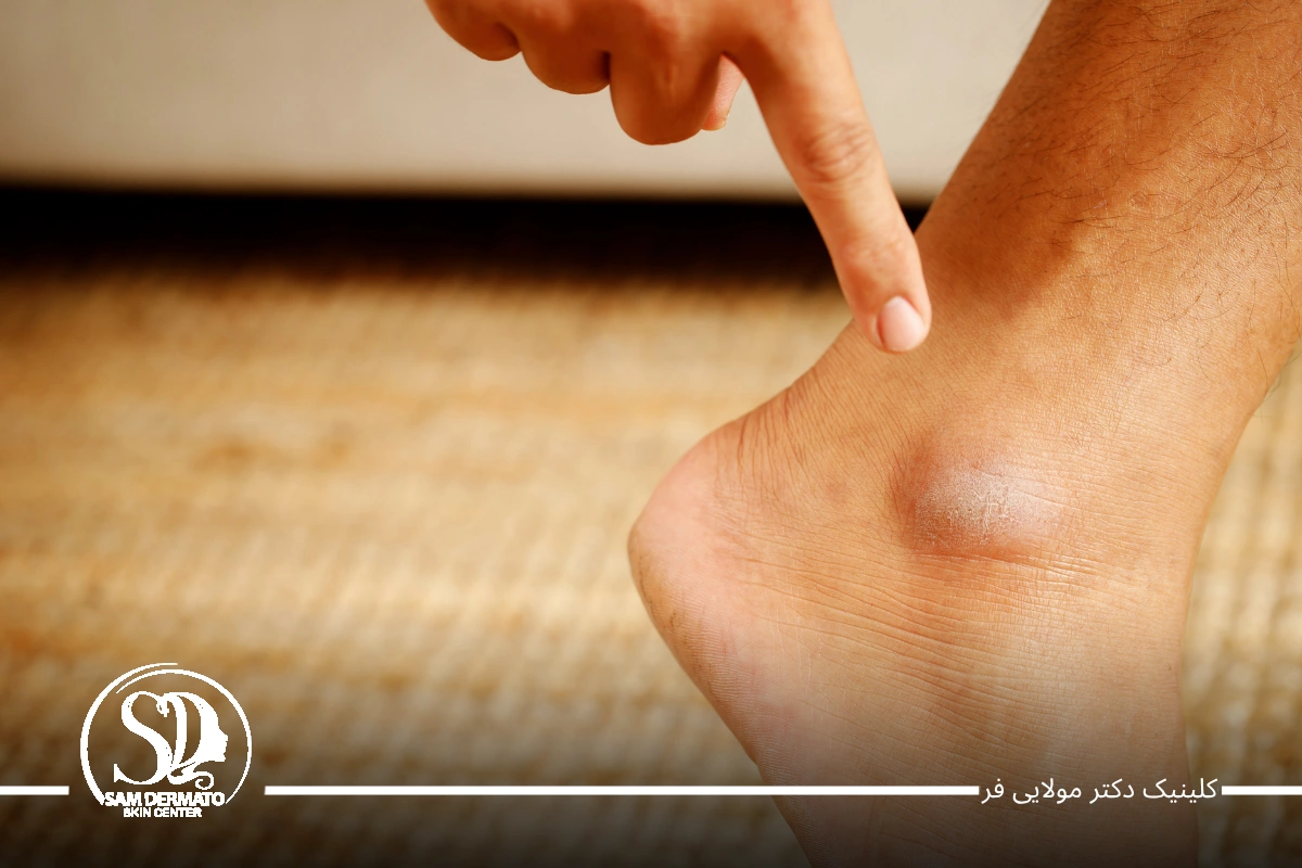 اندولیفت مچ پا