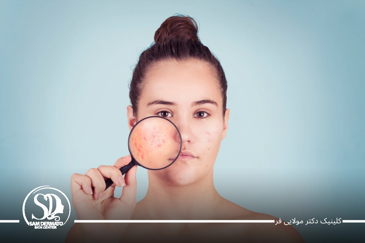 اندولیفت جای جوش