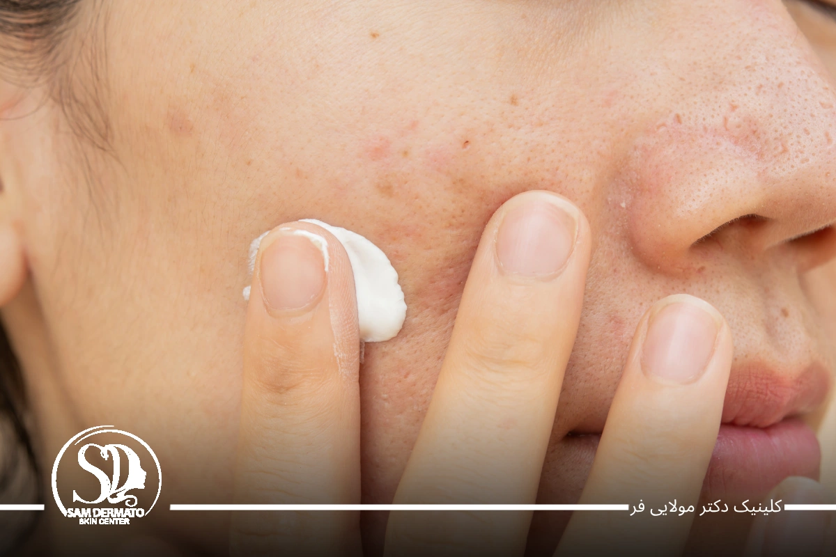 اندولیفت جای جوش