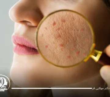 اندولیفت جای جوش
