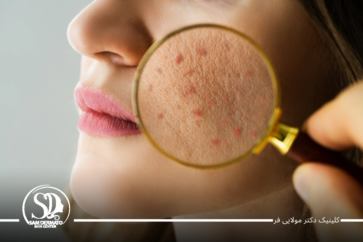 اندولیفت جای جوش