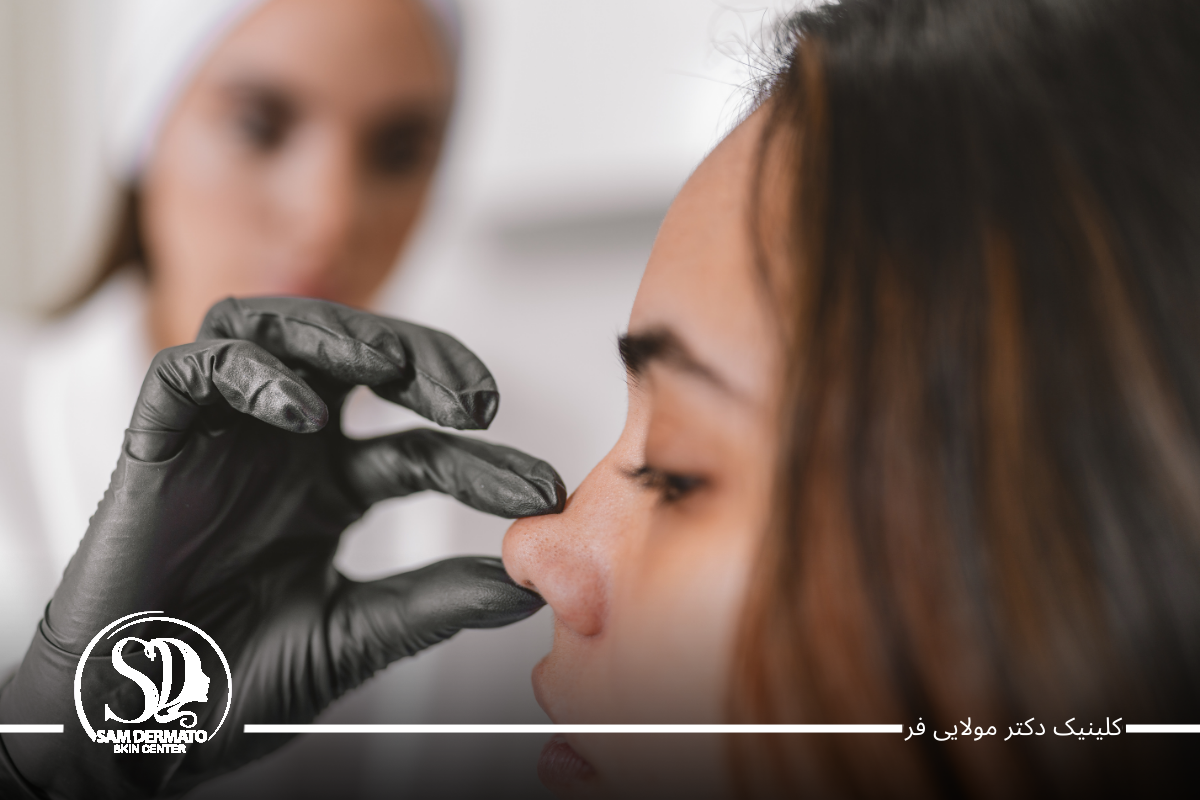 اندولیفت بینی گوشتی،اصلاح فرم بدون درد 1 اندولیفت بینی گوشتی