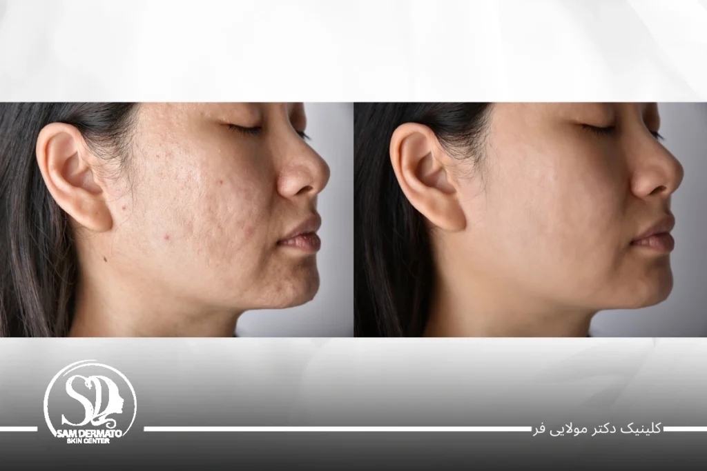 سابسیژن با اندولیفت 3 سابسیژن با اندولیفت