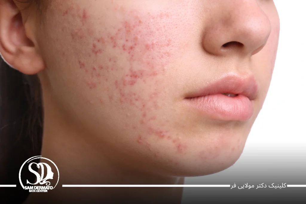 سابسیژن با اندولیفت 2 سابسیژن با اندولیفت
