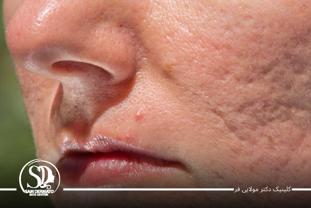 سابسیژن با اندولیفت 5 سابسیژن با اندولیفت