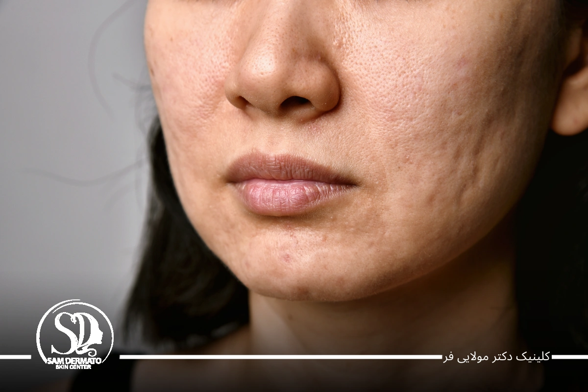 سابسیژن با اندولیفت