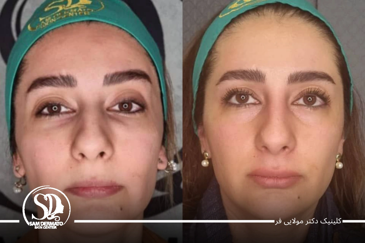 هزینه اندولیفت زیر چشم
