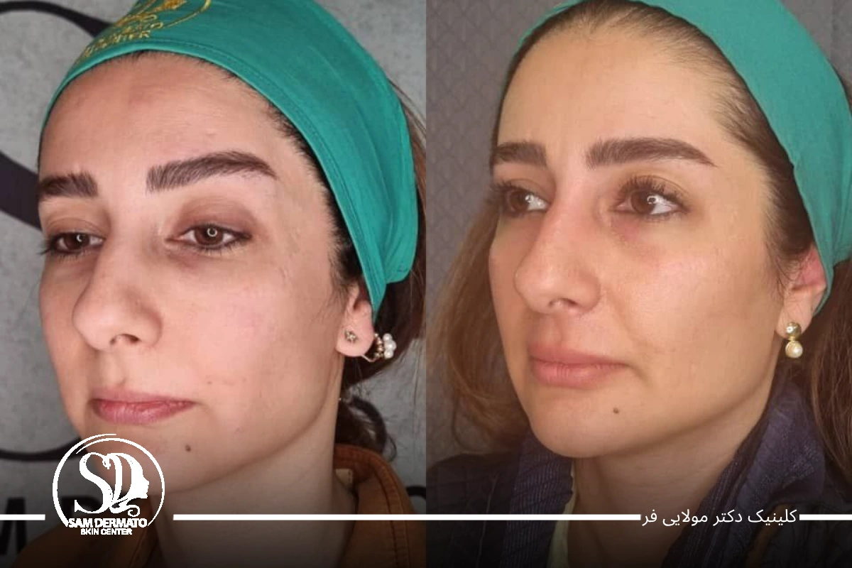 هزینه اندولیفت زیر چشم