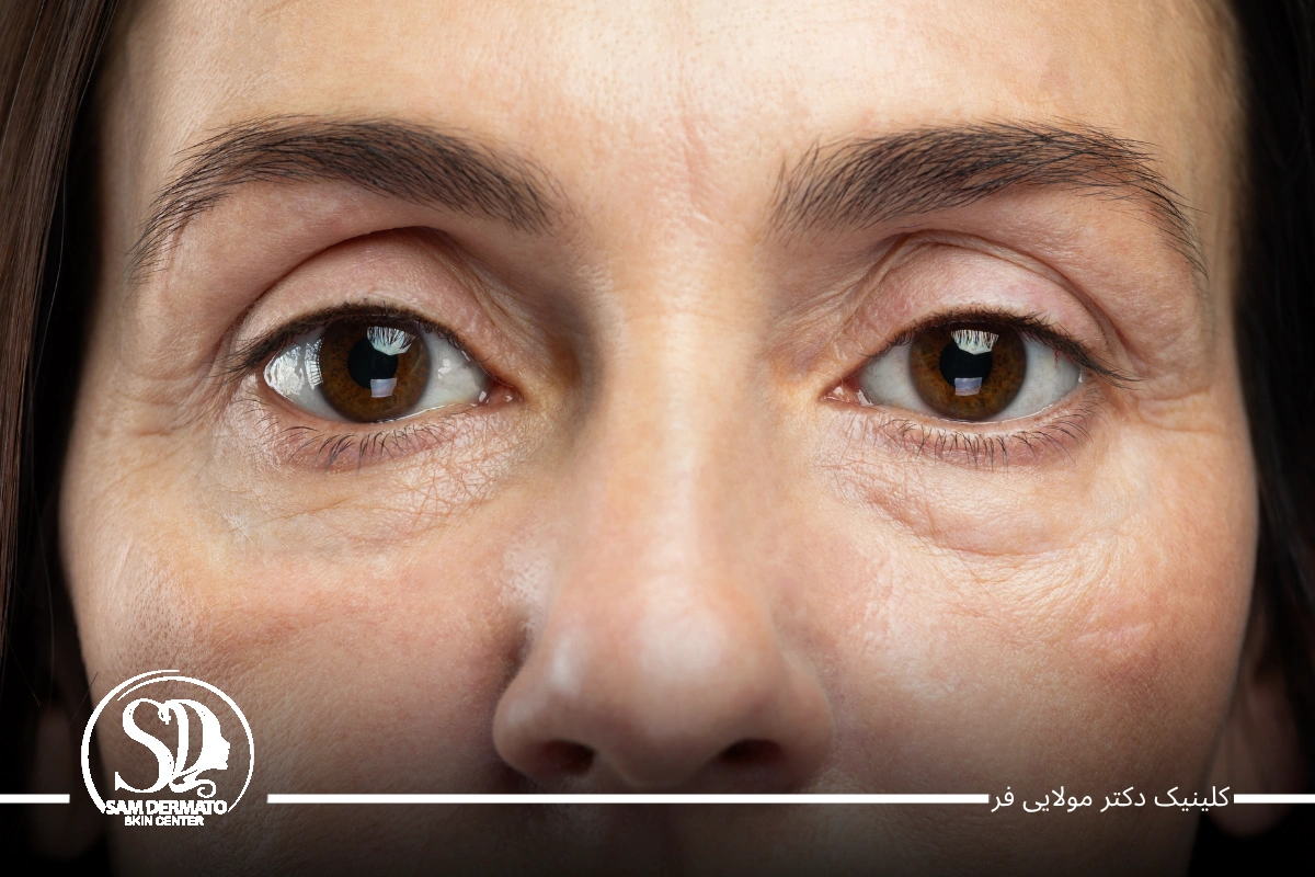 هزینه اندولیفت زیر چشم