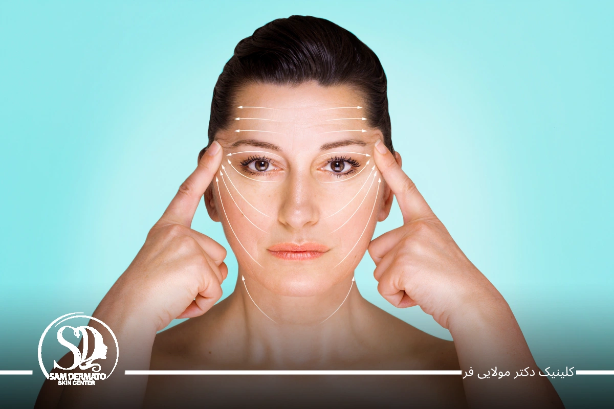هزینه اندولیفت زیر چشم