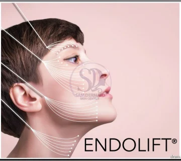 Upper eyelid endolift