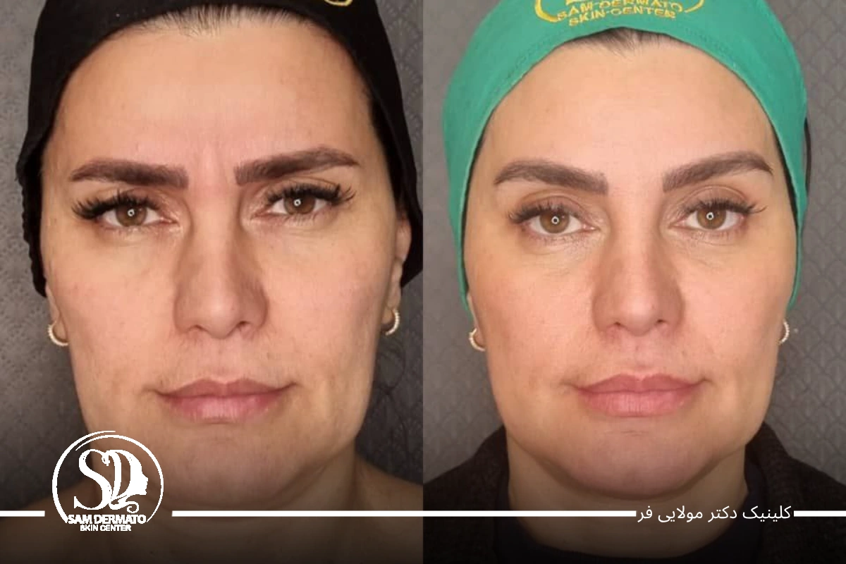 اندولیفت صورت