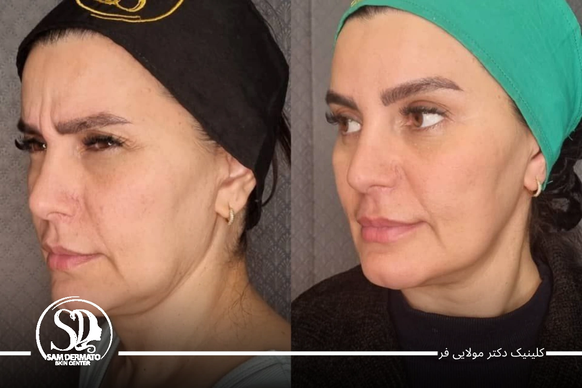 اندولیفت صورت