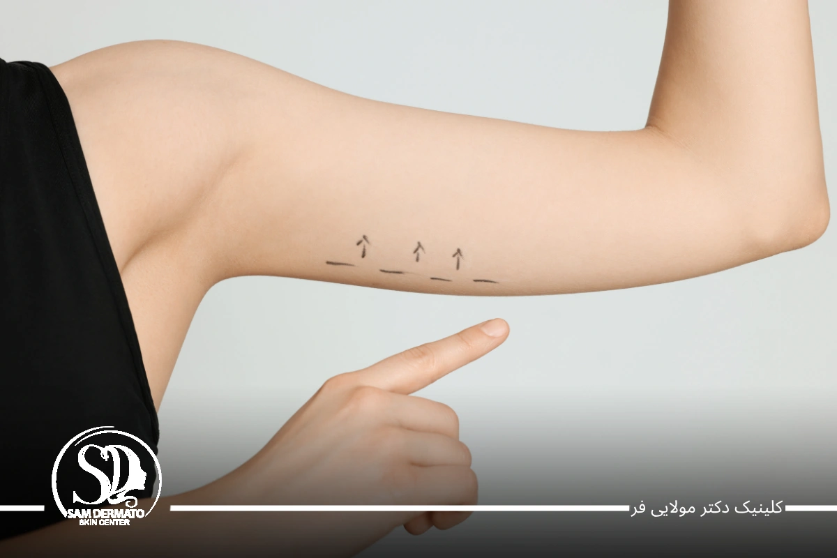 اندولیفت بازو