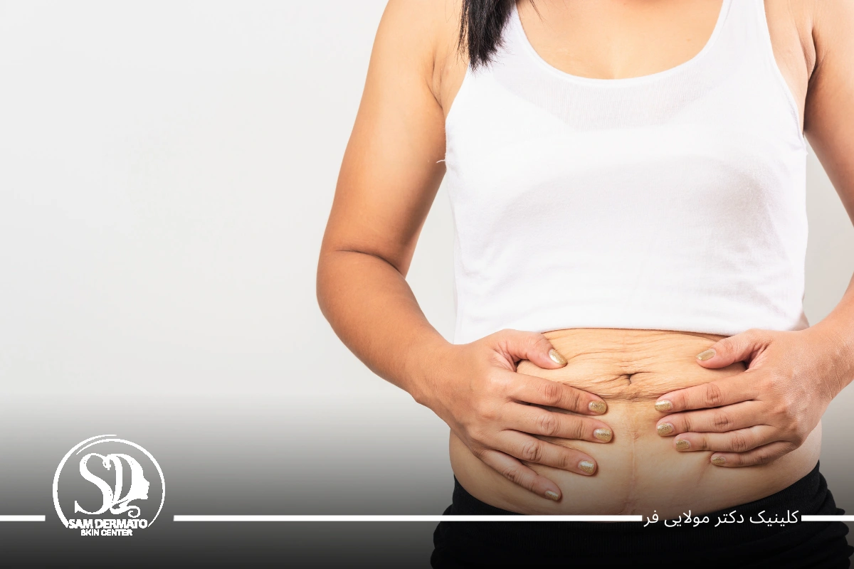 اندولیفت زیر شکم