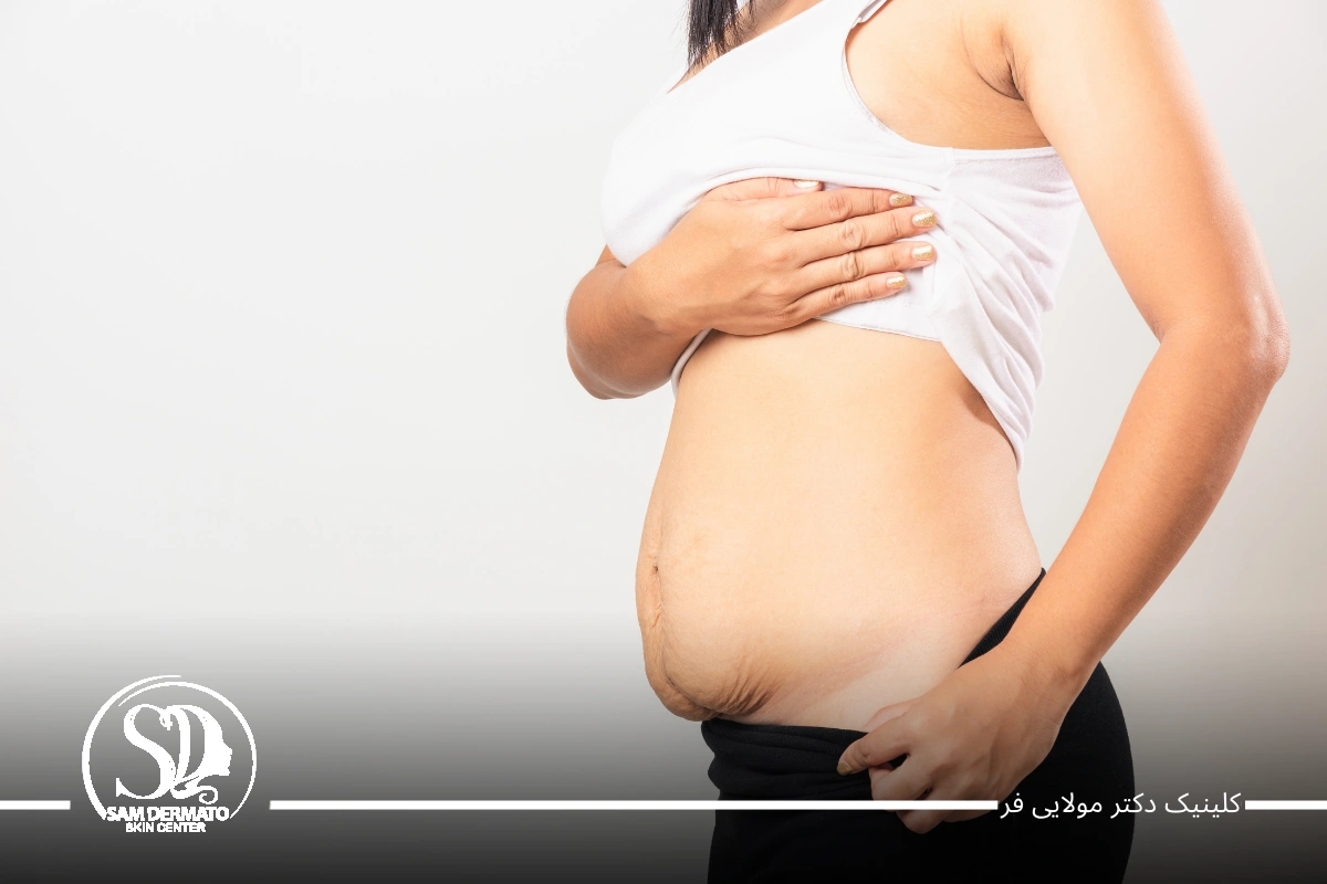 اندولیفت زیر شکم