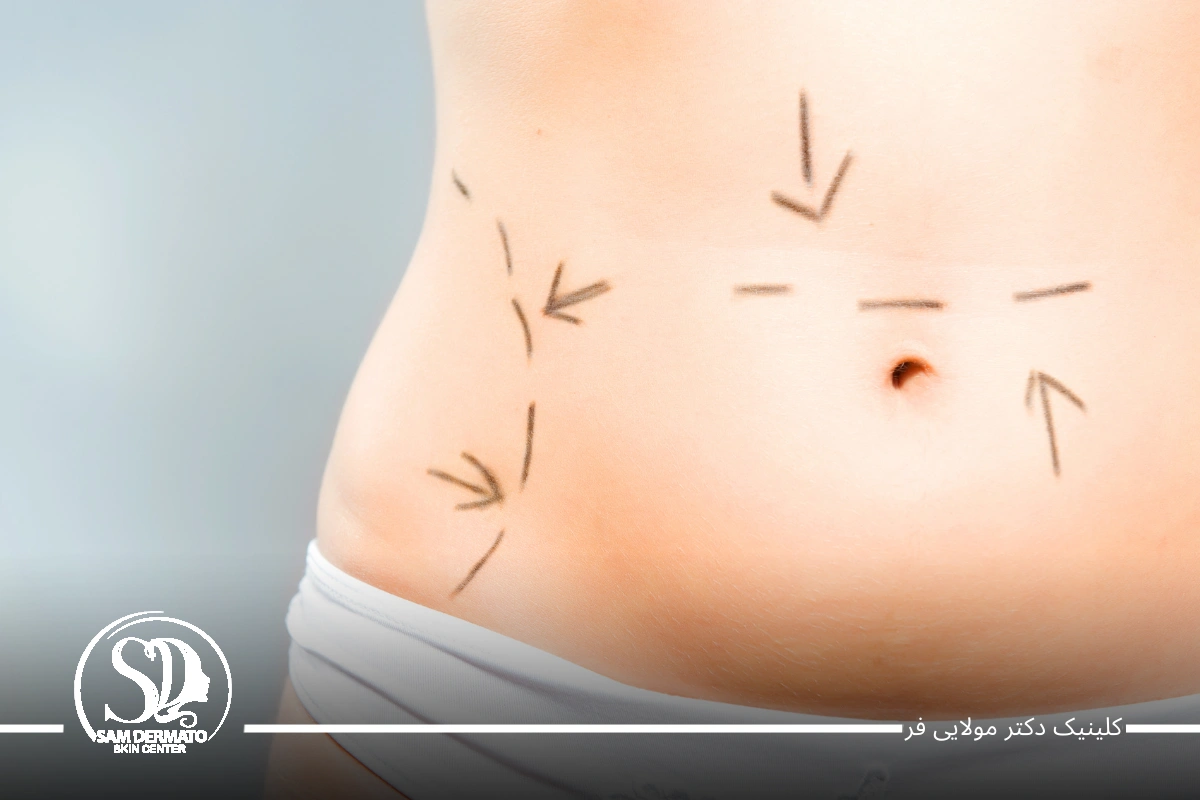 اندولیفت زیر شکم