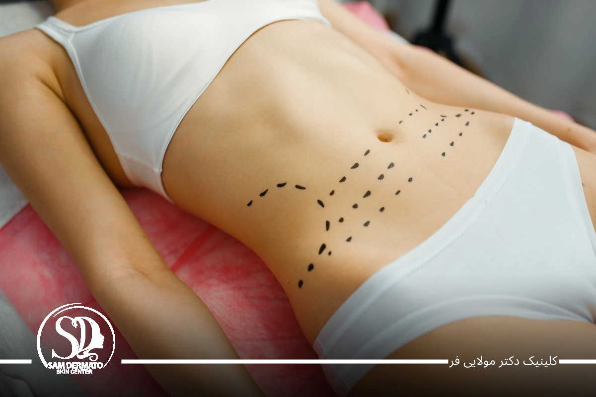 اندولیفت زیر شکم